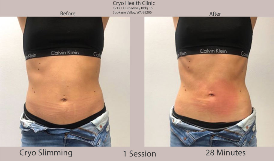 Before and after CRYOSKIN Slimming. Book now! www.cryohealthclinic.com or call 509-921-9800