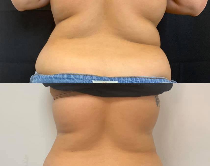 Reduce love handles and unwanted back fat with CryoSlimming. This is after just 2 treatments!